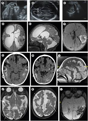 Case report: Novel insights into hemorrhagic destruction of the brain, subependymal calcification, and cataracts disease